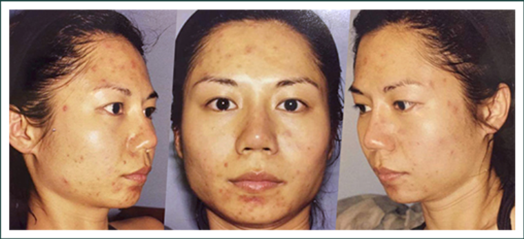 How to lighten acne marks & scars
