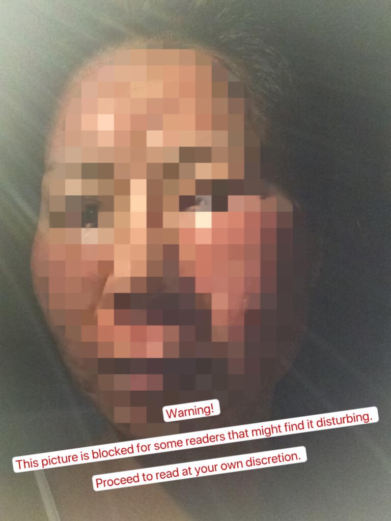 This could be you if your post facial care is mishandled!