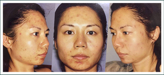 How to lighten acne marks & scars